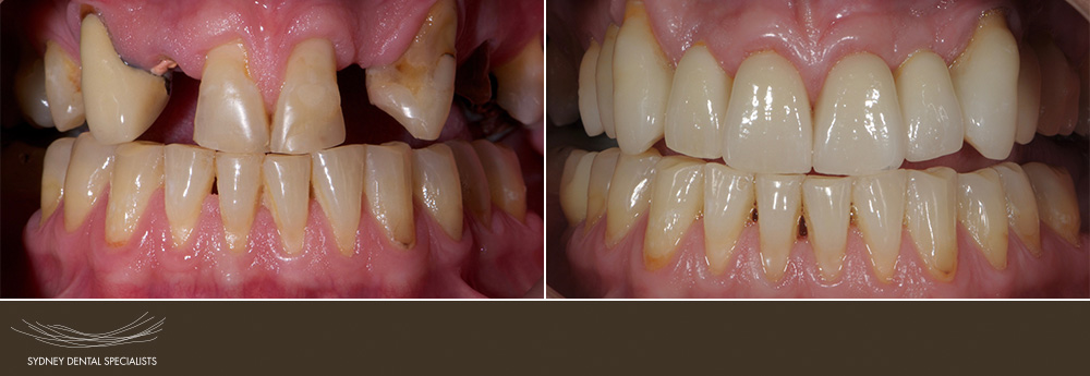 sydneydentalspecialists-homepagebeforeafter-02