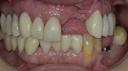 Implant-supported bridges/dentures