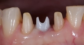 Implant-supported bridges/dentures