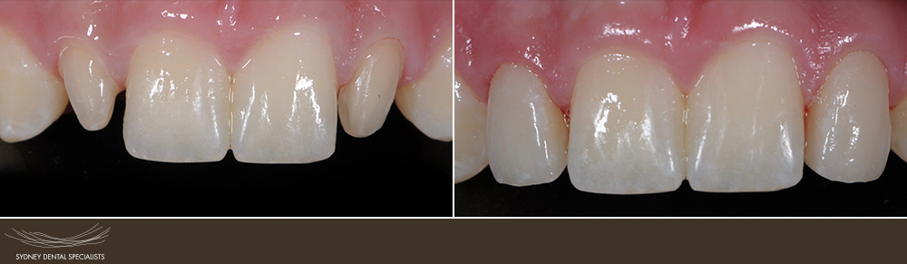 sydneydentalspecialists-beforeandafters-agnewjohn