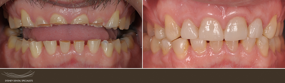 sydneydentalspecialists-beforeandafters-bertiluet