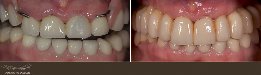 sydneydentalspecialists-beforeandafters-carneynancy