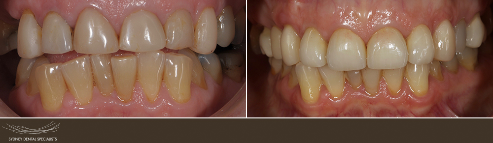 sydneydentalspecialists-beforeandafters-corrigansue