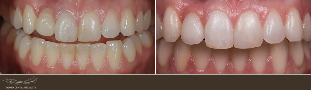 sydneydentalspecialists-beforeandafters-kingkrista